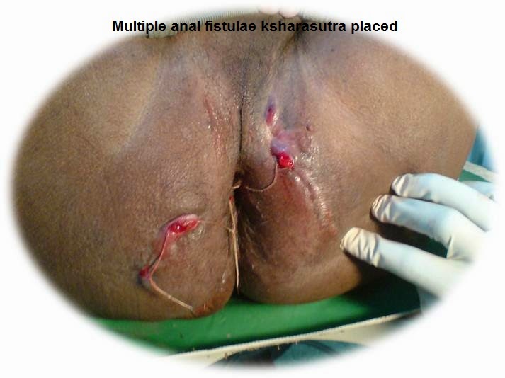 surgery loose anus picture xxx nauheed all hot nude photo sex
